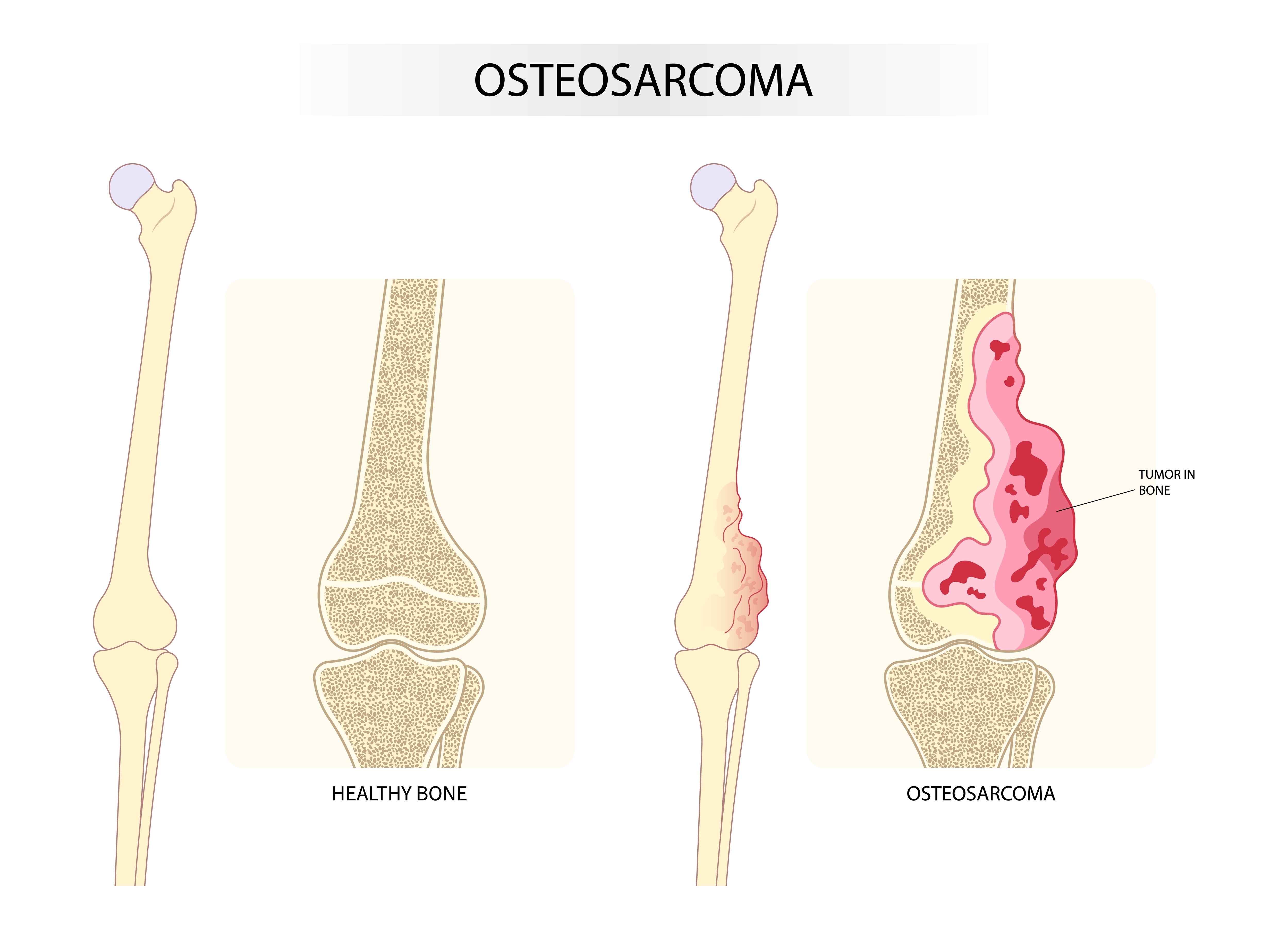 causes-of-bone-cancer